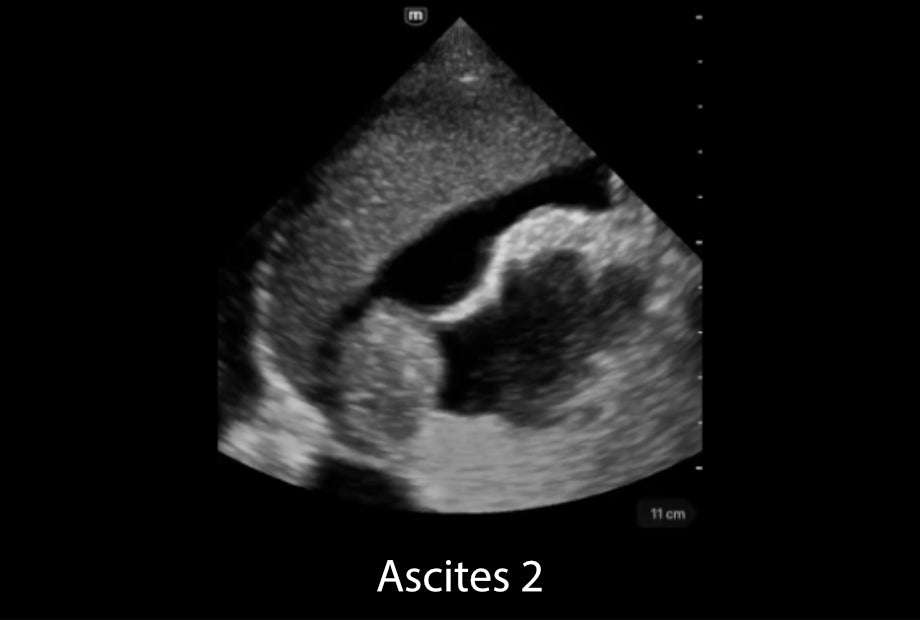 TE Air Series clinical image - Ascites