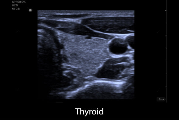 Clinical image - Thyroid