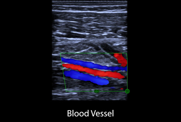 Clinical image - Blood Vessel