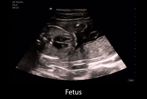 Clinical image - Fetus