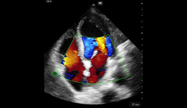 TE Air Series clinical image - Cardiac A4C Color mode