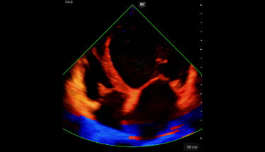 TE Air Series clinical image - Cardiac A4C DCM TDI