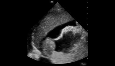 TE Air Series clinical image - Abdomen Ascites