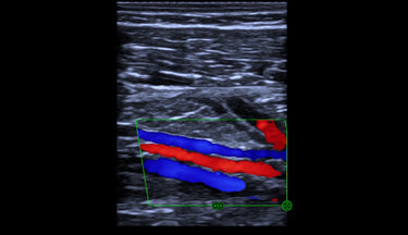 Clinical image/video cover - Blood Vessel 