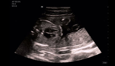 Clinical image/video cover - Fetus