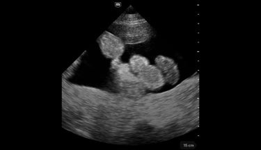 TE Air Series clinical image - Abdomen Ascites