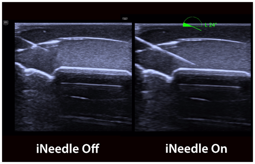 e5M iNeedle Function On and Off Comparision