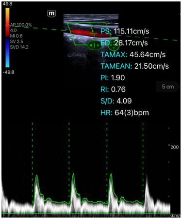 e5M PW Mode Auto Calc Clinical Image