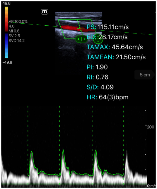 e5M PW Mode Auto Calc Clinical Image